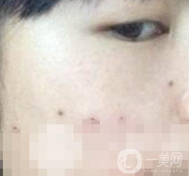 青醫(yī)附院激光去痣多少錢?案例及整形價格表分享