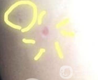 青醫(yī)附院激光去痣多少錢?案例及整形價格表分享