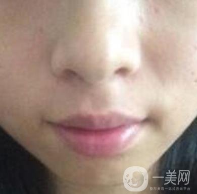 青醫(yī)附院激光去痣多少錢?案例及整形價格表分享