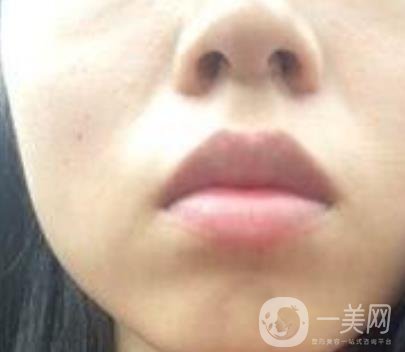 青醫(yī)附院激光去痣多少錢?案例及整形價格表分享