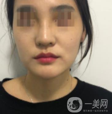 深圳人民醫(yī)院整形外科價目表，附隆鼻案例