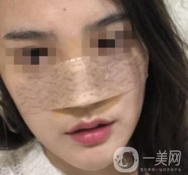 深圳人民醫(yī)院整形外科價目表，附隆鼻案例