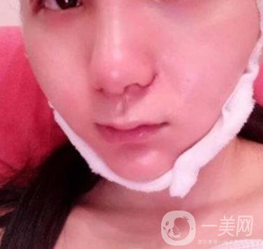 浙一醫(yī)院*誰打的好?附真人案例及整形價格表