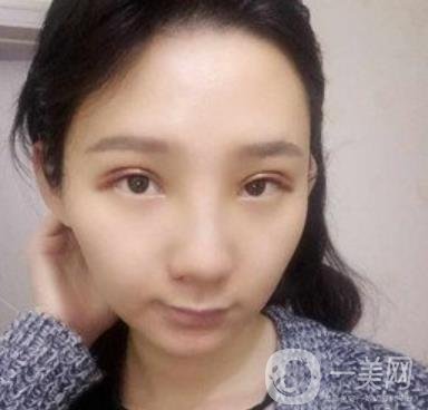 浙一醫(yī)院*誰打的好?附真人案例及整形價格表