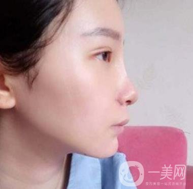 浙一醫(yī)院*誰打的好?附真人案例及整形價格表