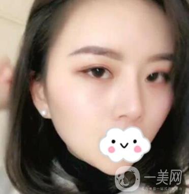 江蘇省中醫(yī)院自體脂肪填充