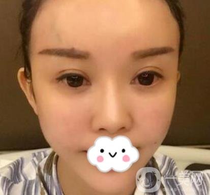 金華中心醫(yī)院自體脂肪填充