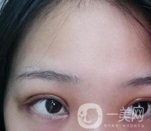 上海華美醫(yī)療美容醫(yī)院價(jià)格表，附雙眼皮修復(fù)案例