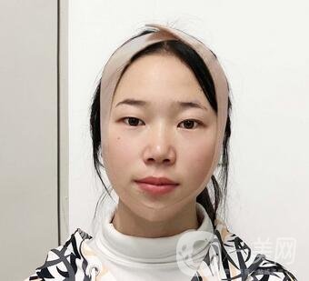 西安高一生醫(yī)療美容醫(yī)院價格表，附面部吸脂案例分享