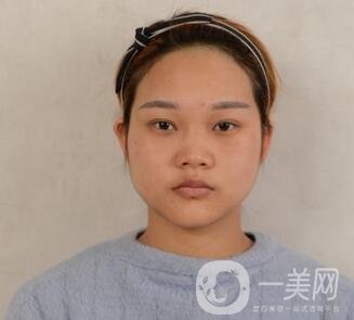 成都銅雀臺(tái)整形醫(yī)院隆鼻案例分享，附全新價(jià)格表