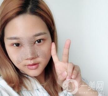 成都銅雀臺(tái)整形醫(yī)院隆鼻案例分享，附全新價(jià)格表