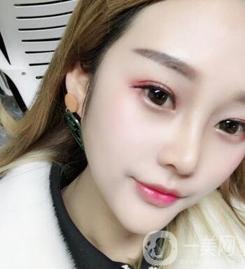 成都銅雀臺(tái)整形醫(yī)院隆鼻案例分享，附全新價(jià)格表