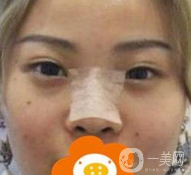 蚌埠美萊塢整形醫(yī)院玻尿酸隆鼻*果如何？?jī)r(jià)格表2020年收費(fèi)公布