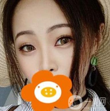 蚌埠美萊塢整形醫(yī)院玻尿酸隆鼻*果如何？?jī)r(jià)格表2020年收費(fèi)公布