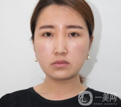 常州美貝爾整形美容醫(yī)院*注射多少錢？價格明細和*果圖展示