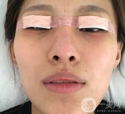 大連市中心醫(yī)院雙眼皮怎么樣？費用是多少？真人恢復經(jīng)歷自述
