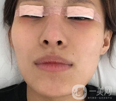 大連市中心醫(yī)院雙眼皮怎么樣？費用是多少？真人恢復經(jīng)歷自述