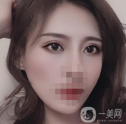 大連市中心醫(yī)院雙眼皮怎么樣？費用是多少？真人恢復經(jīng)歷自述