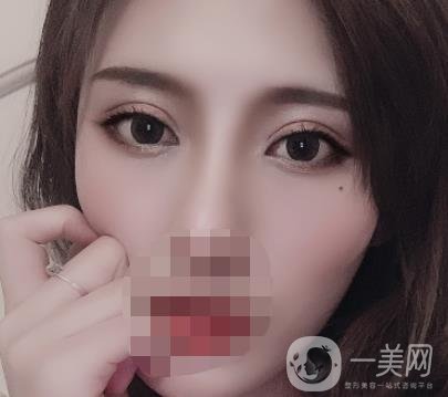 大連市中心醫(yī)院雙眼皮怎么樣？費用是多少？真人恢復經(jīng)歷自述