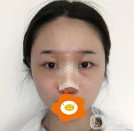 南京美貝爾整形醫(yī)院做*好不好？價格表費用明細和*果圖參考