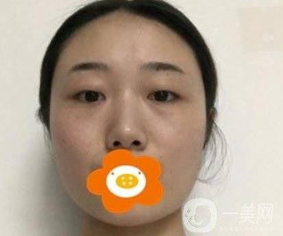 南京美貝爾整形醫(yī)院做*好不好？價格表費用明細和*果圖參考