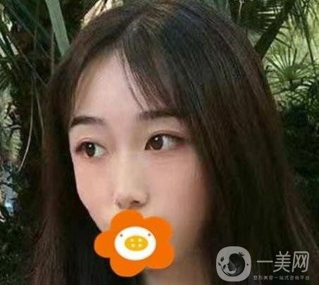 南京美貝爾整形醫(yī)院做*好不好？價格表費用明細和*果圖參考