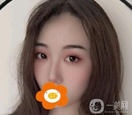 南京美貝爾整形醫(yī)院做*好不好？價格表費用明細和*果圖參考