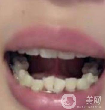 廣東省口腔醫(yī)院正畸價格表及案例恢復過程分享