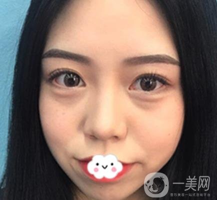 廣東省人民醫(yī)院整形科去眼袋怎么樣?內(nèi)含案例及價格一覽表