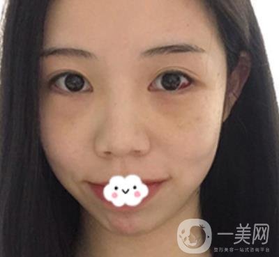廣東省人民醫(yī)院整形科去眼袋怎么樣?內(nèi)含案例及價格一覽表