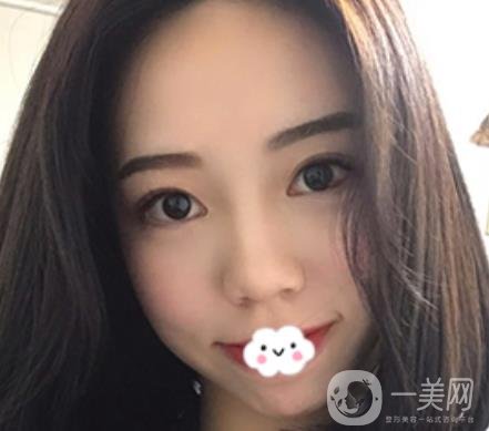 廣東省人民醫(yī)院整形科去眼袋怎么樣?內(nèi)含案例及價格一覽表