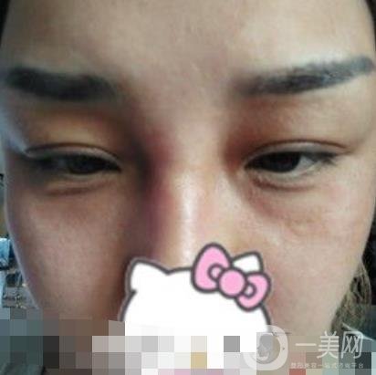 廣西醫(yī)科大一附院去眼袋怎么樣?整形價格表及案例*果圖分享