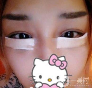 廣西醫(yī)科大一附院去眼袋怎么樣?整形價格表及案例*果圖分享