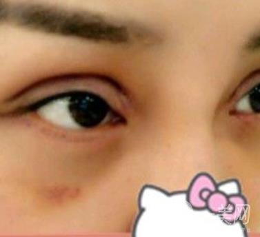 廣西醫(yī)科大一附院去眼袋怎么樣?整形價格表及案例*果圖分享