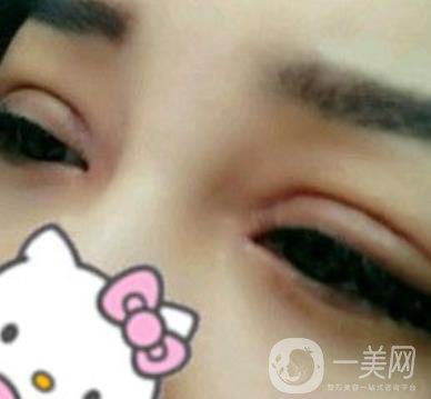 廣西醫(yī)科大一附院去眼袋怎么樣?整形價格表及案例*果圖分享