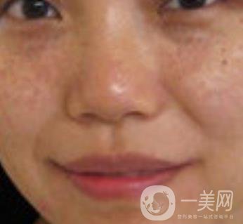 哈醫(yī)大四院整形美容科*新價格表公布,附祛斑真人案例