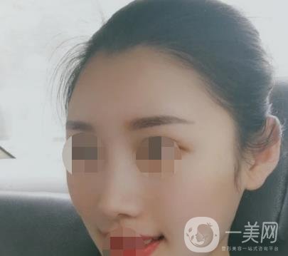 青醫(yī)附院王彥進(jìn)去痣怎么樣？?jī)r(jià)格表及*果展示