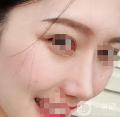 青醫(yī)附院王彥進(jìn)去痣怎么樣？?jī)r(jià)格表及*果展示