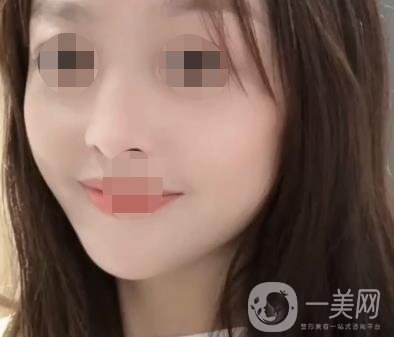 漳州175醫(yī)院整形美容科價格表（收費表）,及祛斑案例*果分享