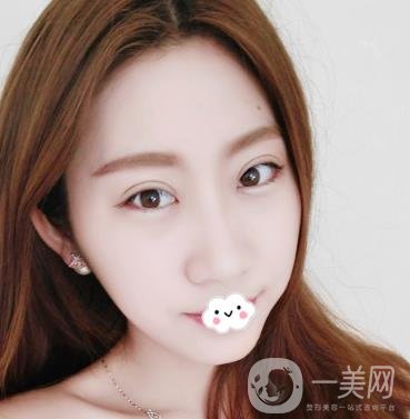 沈陽百嘉麗醫(yī)院價格表2020，附雙眼皮案例分享