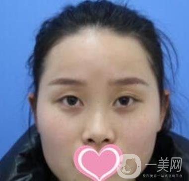 沈陽名流整形醫(yī)院價格表，附雙眼皮+隆鼻案例