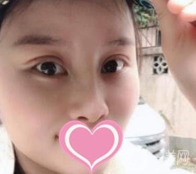 沈陽名流整形醫(yī)院價格表，附雙眼皮+隆鼻案例