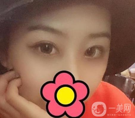 沈陽(yáng)杏林整形醫(yī)院割雙眼皮*果咋樣?看實(shí)例及價(jià)格表