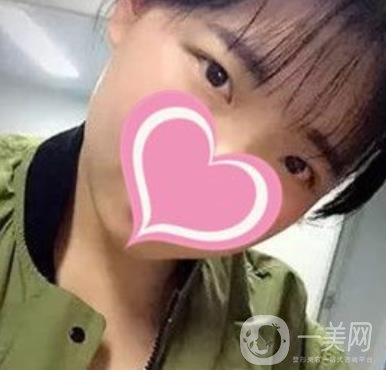 濟(jì)南中心醫(yī)院價格表，雙眼皮整形日記公布