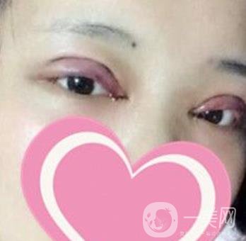 濟(jì)南中心醫(yī)院價格表，雙眼皮整形日記公布