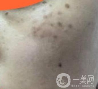 沈陽伊美爾整形醫(yī)院價格表，附祛斑*果展示