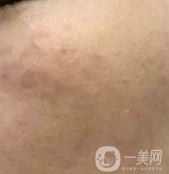 沈陽伊美爾整形醫(yī)院價格表，附祛斑*果展示