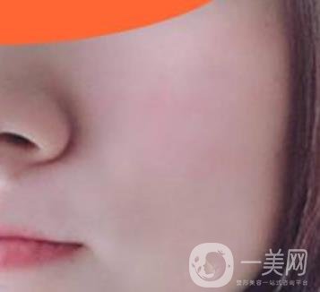 沈陽伊美爾整形醫(yī)院價格表，附祛斑*果展示