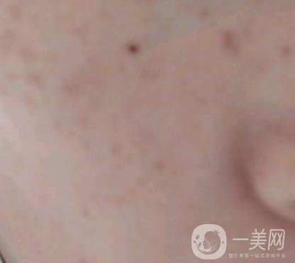 上海星和醫(yī)美整形醫(yī)院*祛斑*果圖和價格價目表2020年