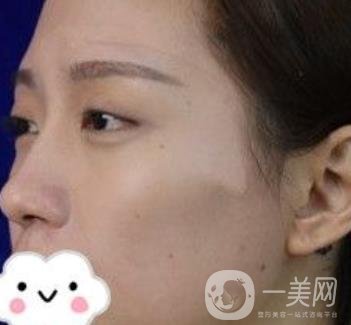 臺州博雅美惠醫(yī)療美容整形雙眼皮恢復日記，內(nèi)附價格表明細